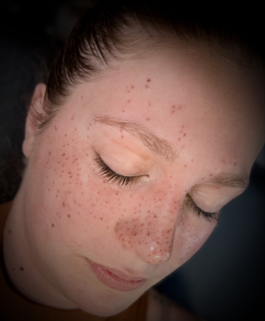 Freckles